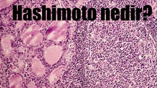 Hashimoto nedir? Hashimoto nasıl tedavi edilir?