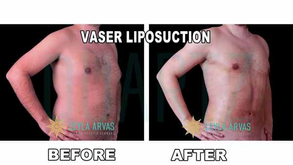 Açıklama: Yağ Aldırma | Vaser Liposuction (Liposakşın) Ameliyatı | Önce&Sonra  Sonuçları - YouTube